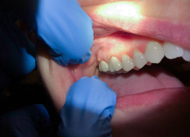Best Knocked-Out Tooth Emergency  in Willmsburg, IA